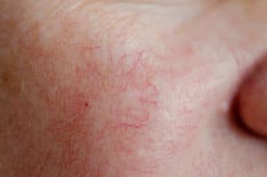  rosacea and rhinophyma treatment