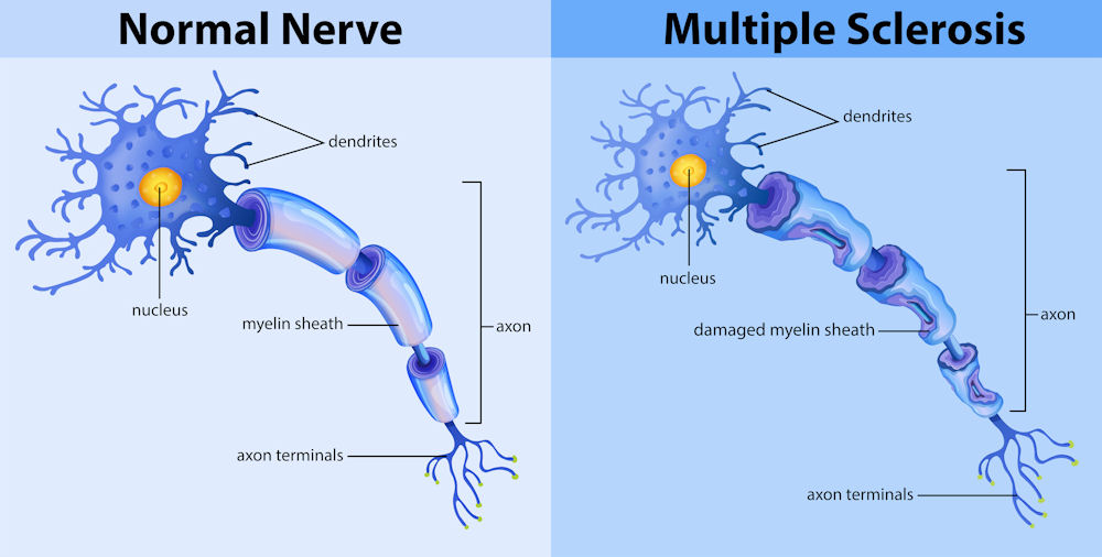 nerve with multiple sclerosis
