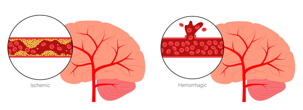 brain stroke