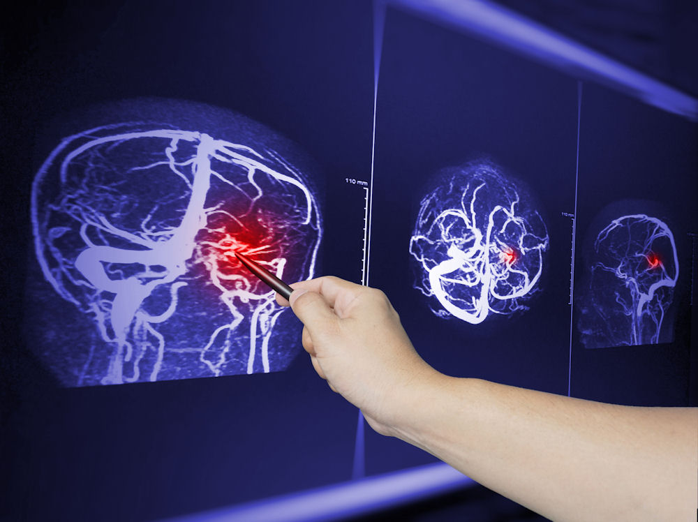 _traumatic brain injury and substance abuse
