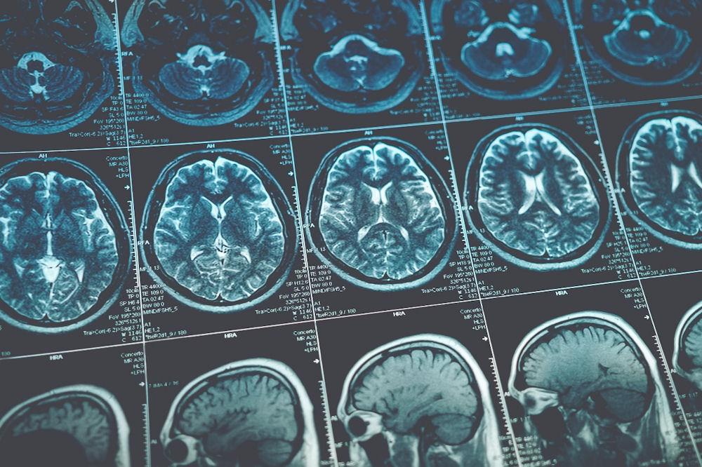alcohol related brain damage
